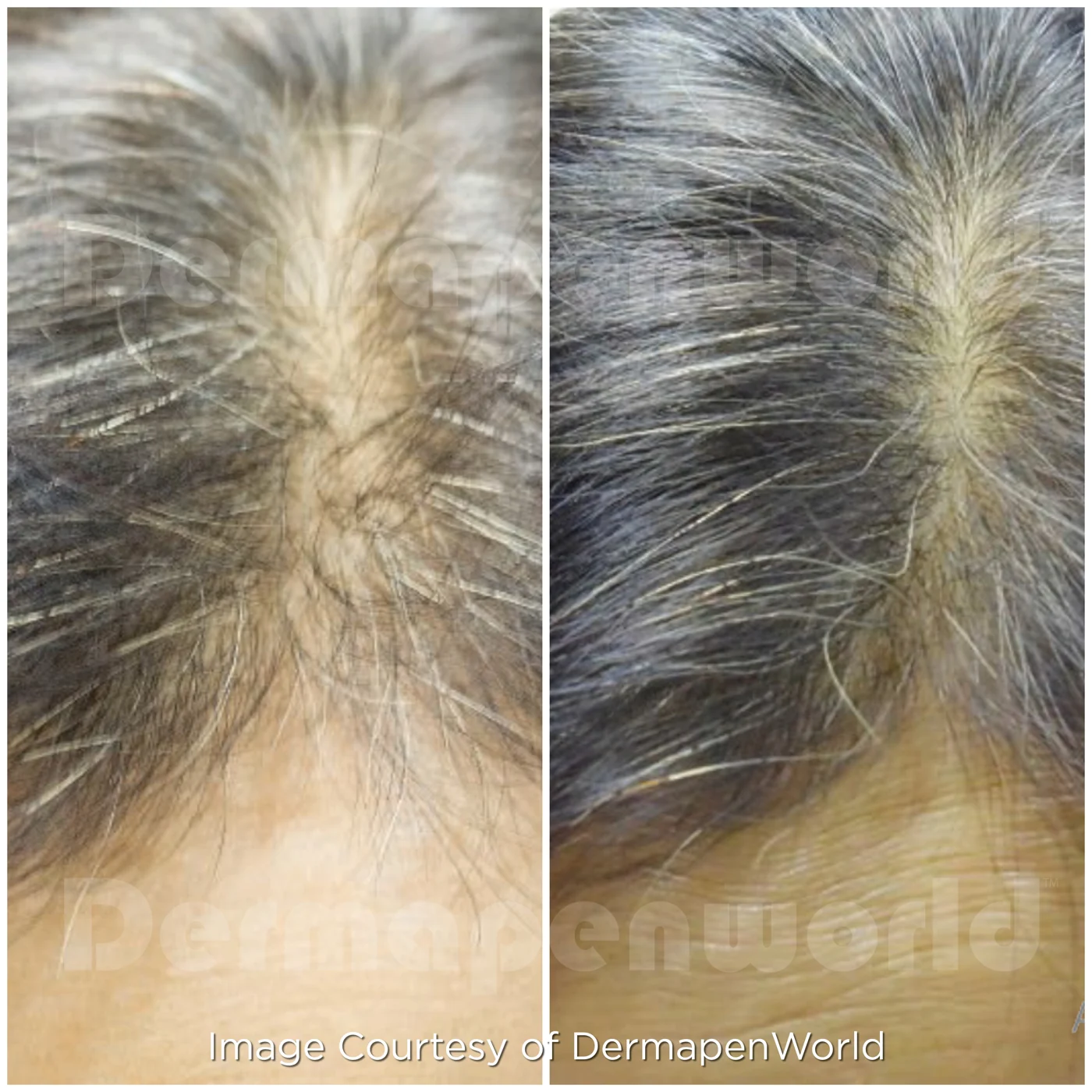 Hair Restoration before and after at Beauty Studio MediSpa, Shenfield