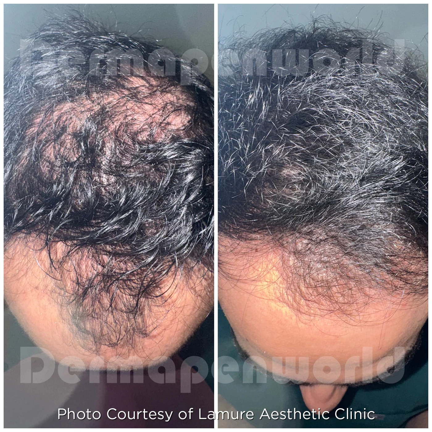 Hair Restoration before and after at Beauty Studio MediSpa, Shenfield