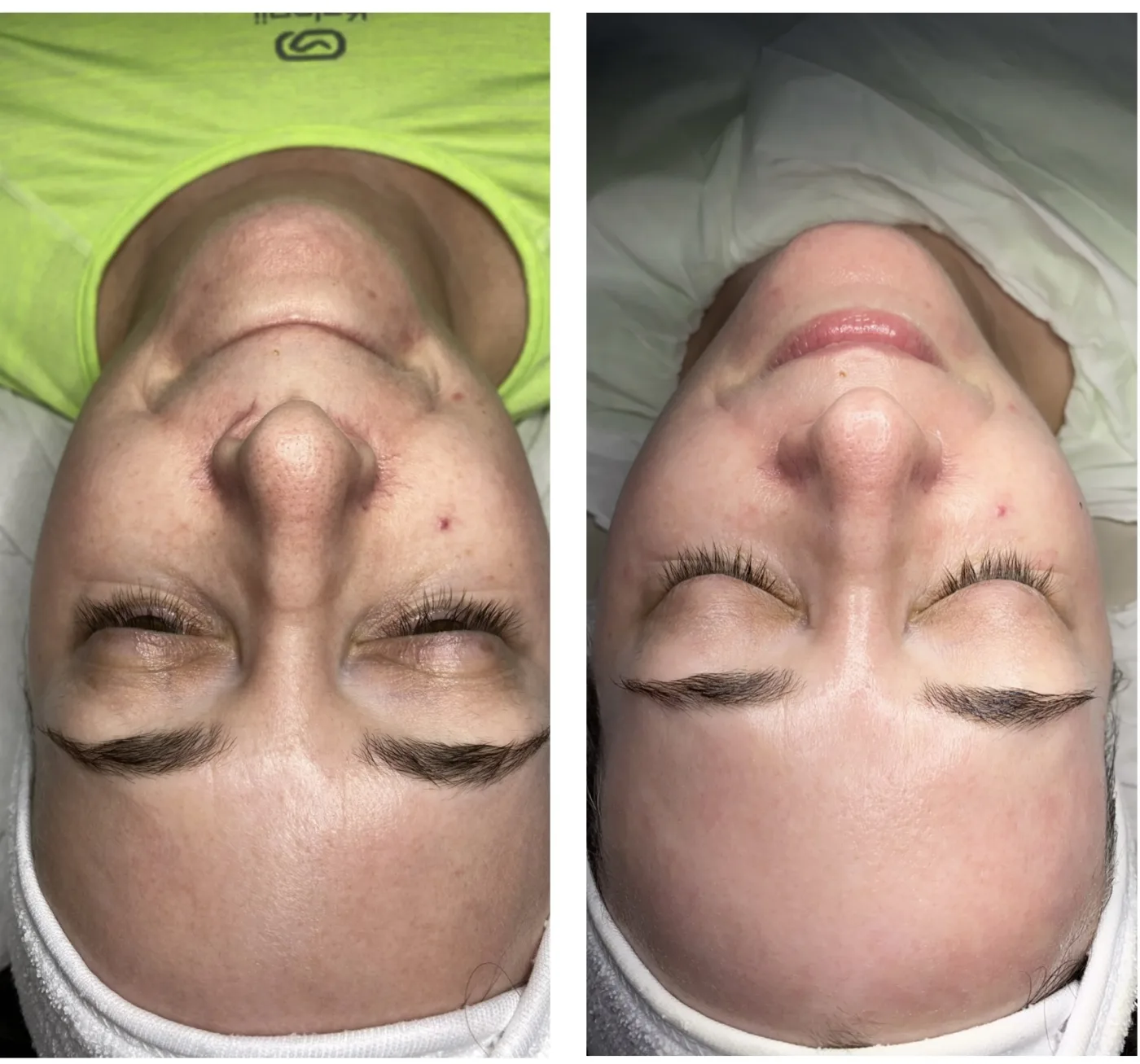 HydraFacial before and after at Beauty Studio MediSpa, Shenfield