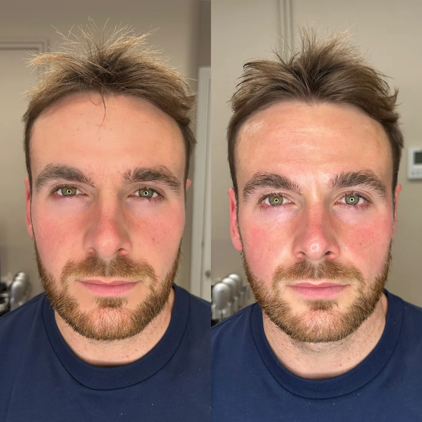 HydraFacial before and after at Beauty Studio MediSpa, Shenfield