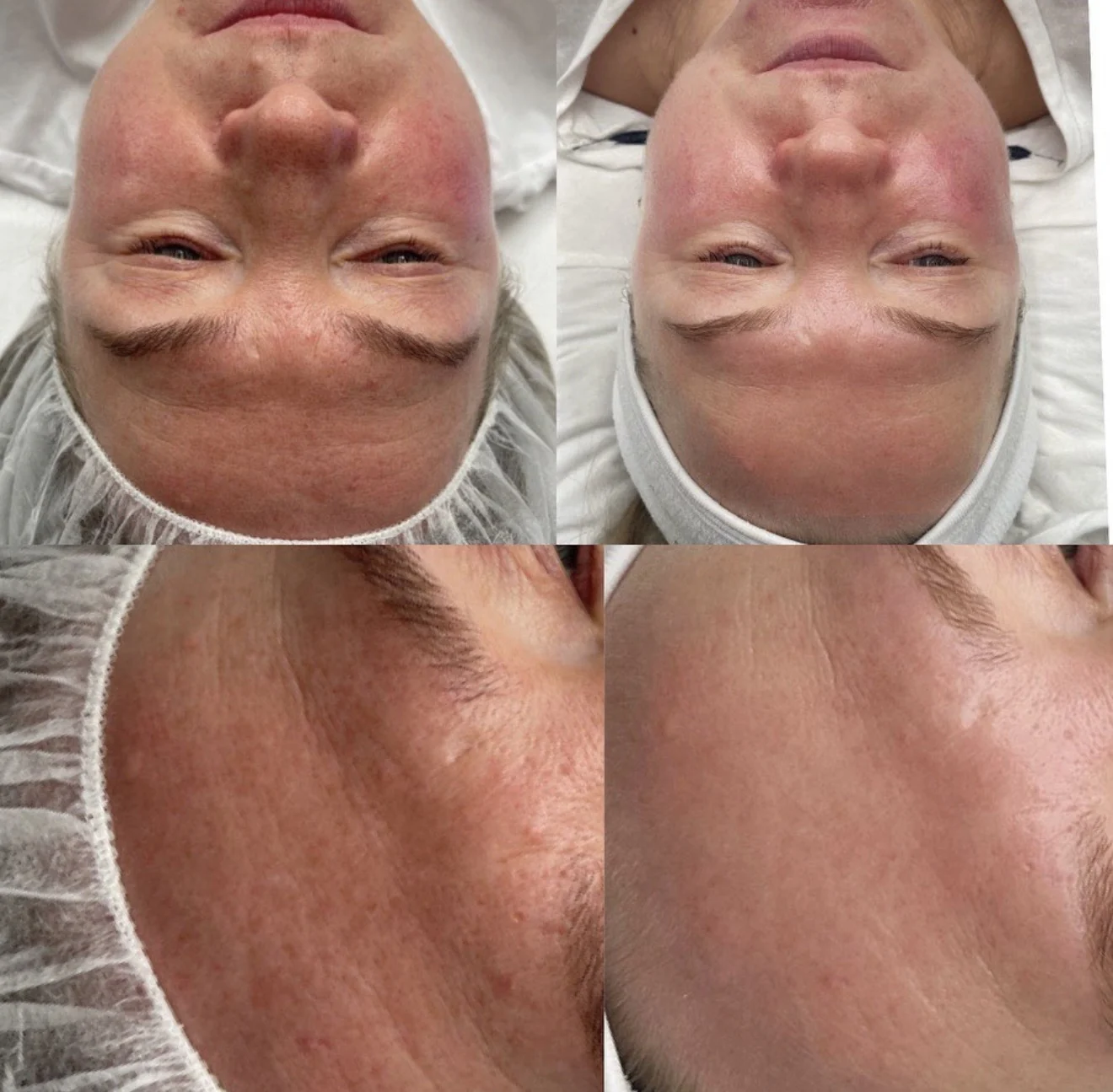 HydraFacial before and after at Beauty Studio MediSpa, Shenfield