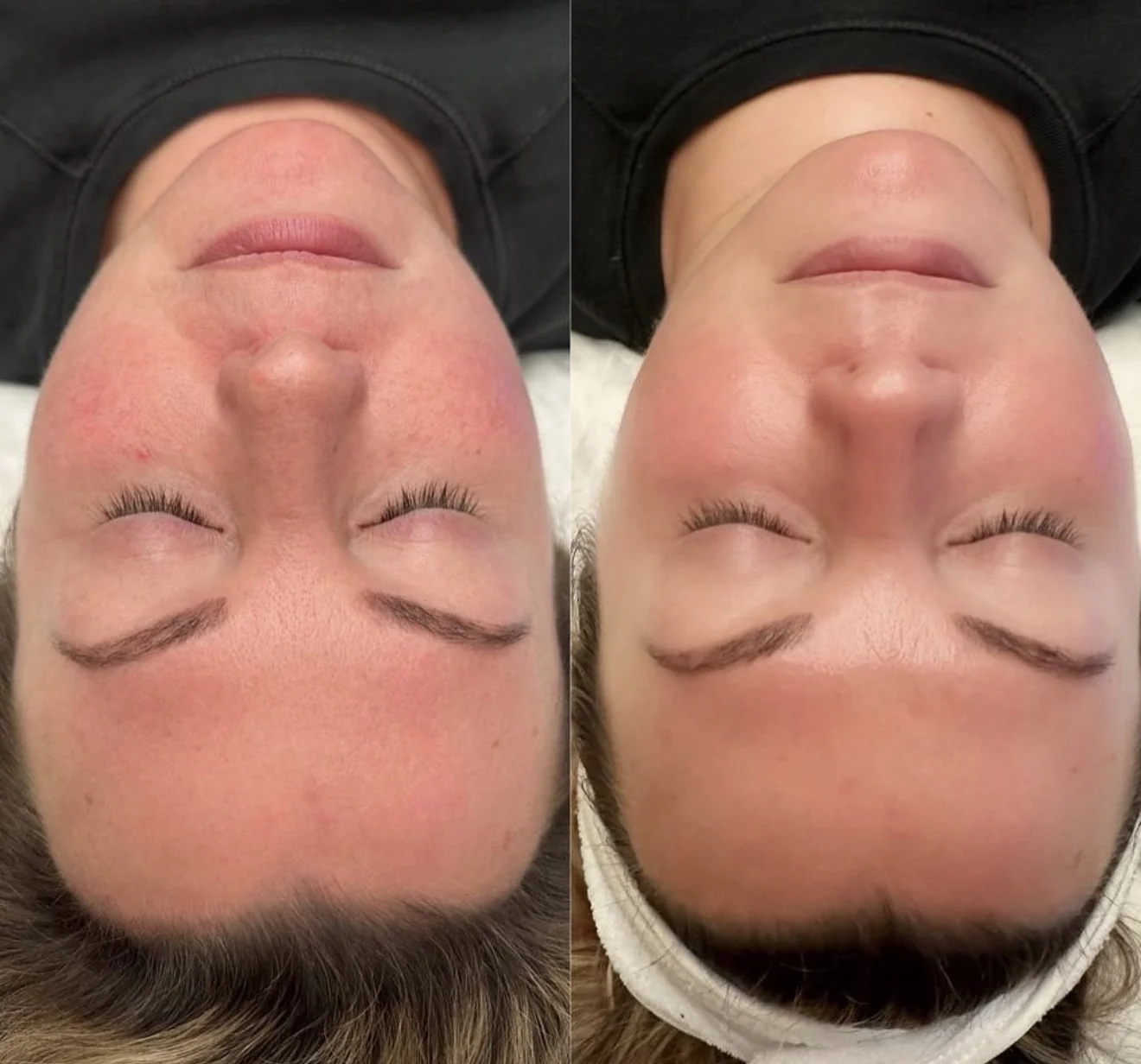 HydraFacial before and after at Beauty Studio MediSpa, Shenfield