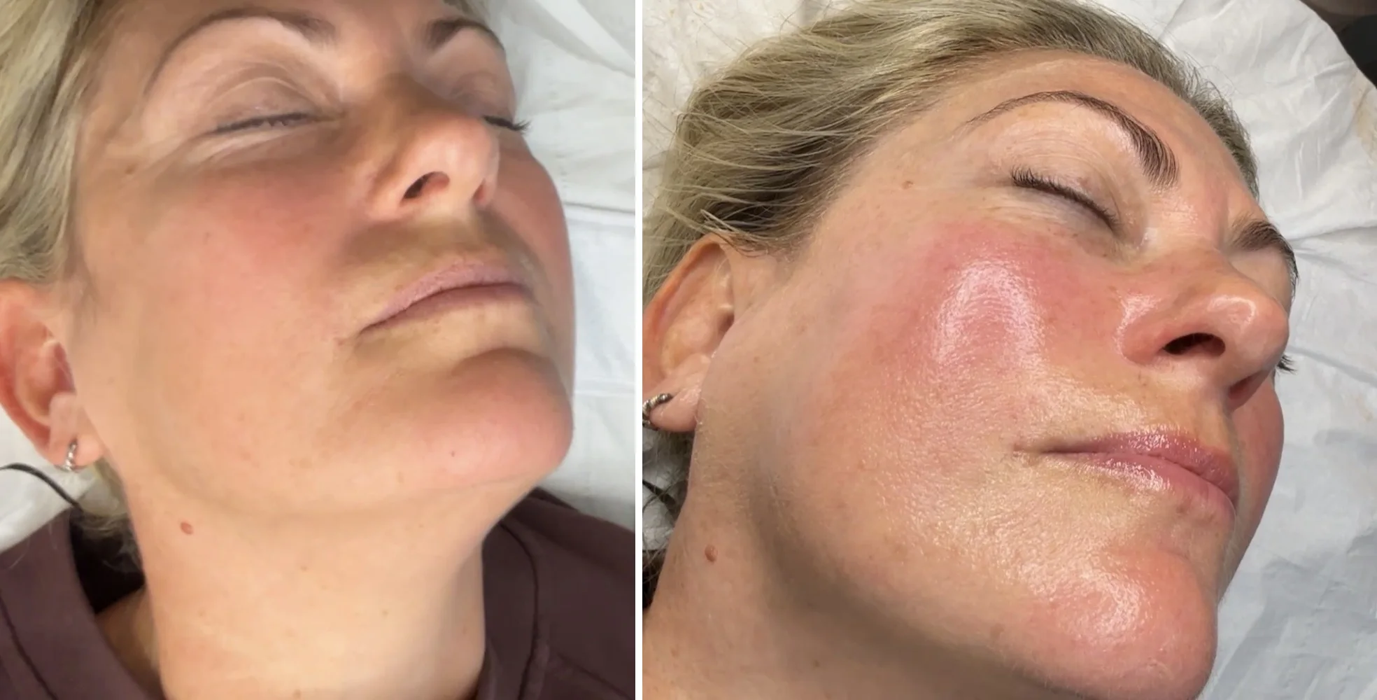 HydraFacial before and after at Beauty Studio MediSpa, Shenfield