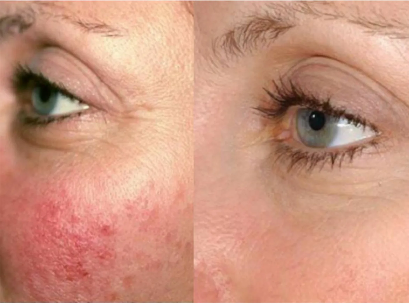 Laser Genesis skin therapy before and after at Beauty Studio MediSpa, Shenfield