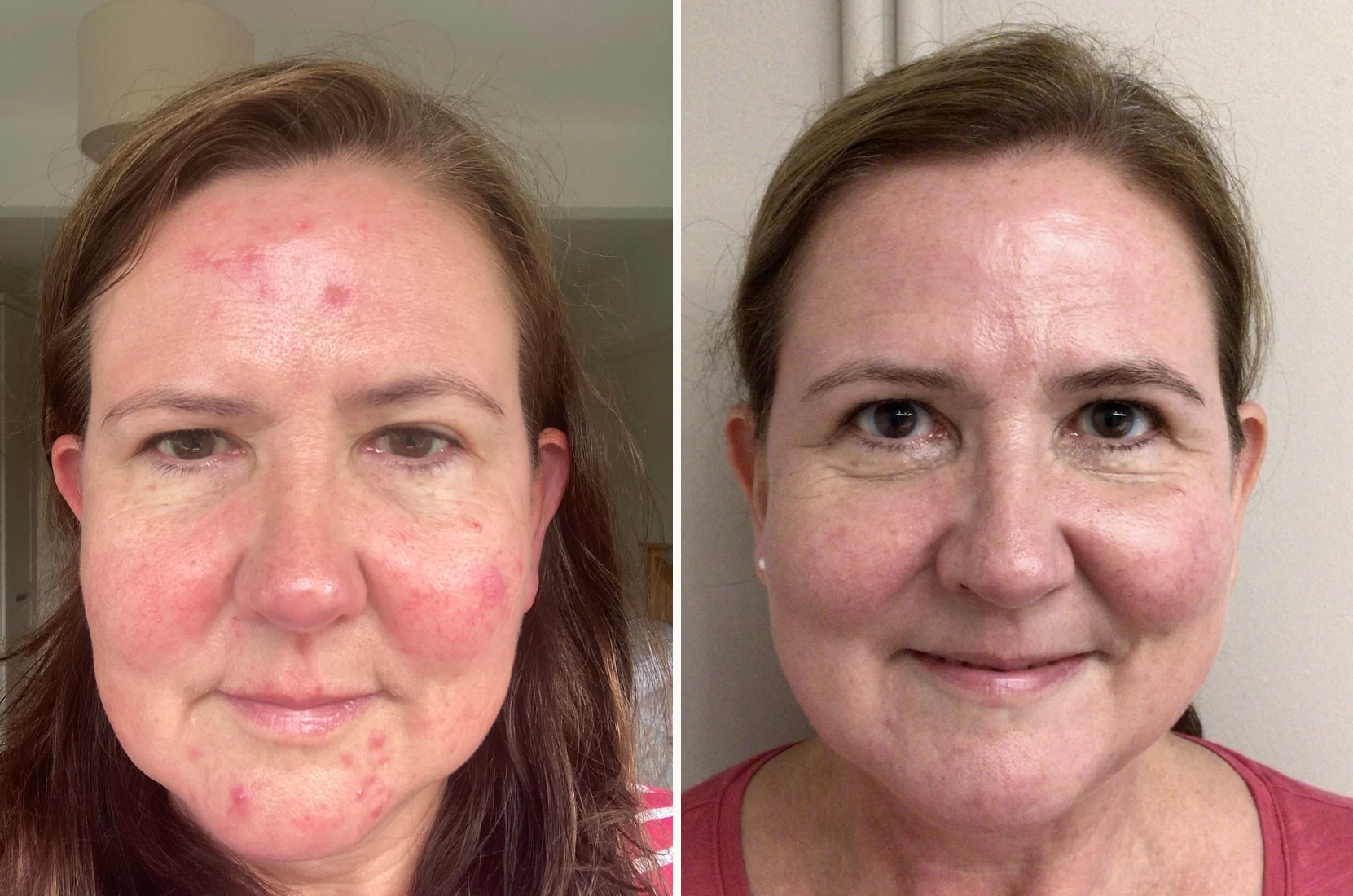 Laser Genesis before and after for rosacea and redness at Beauty Studio MediSpa, Shenfield
