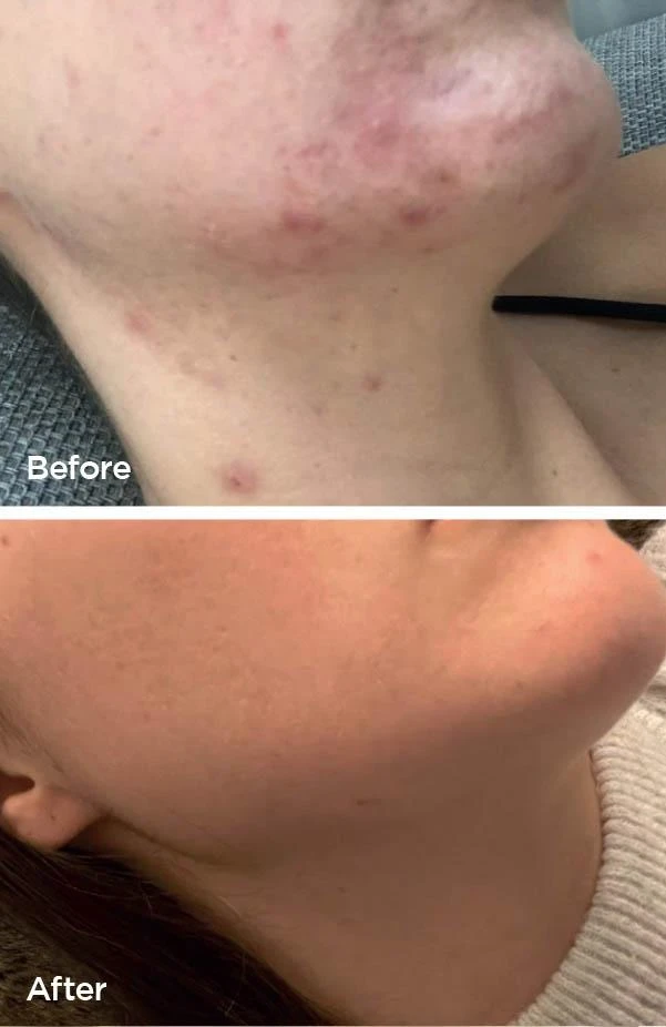 Laser Genesis before and after (acne and congestion) at Beauty Studio MediSpa, Shenfield