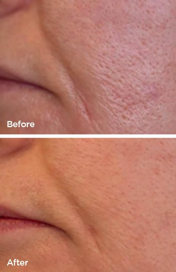 Laser Genesis before and after (rosacea and facial redness) at Beauty Studio MediSpa, Shenfield