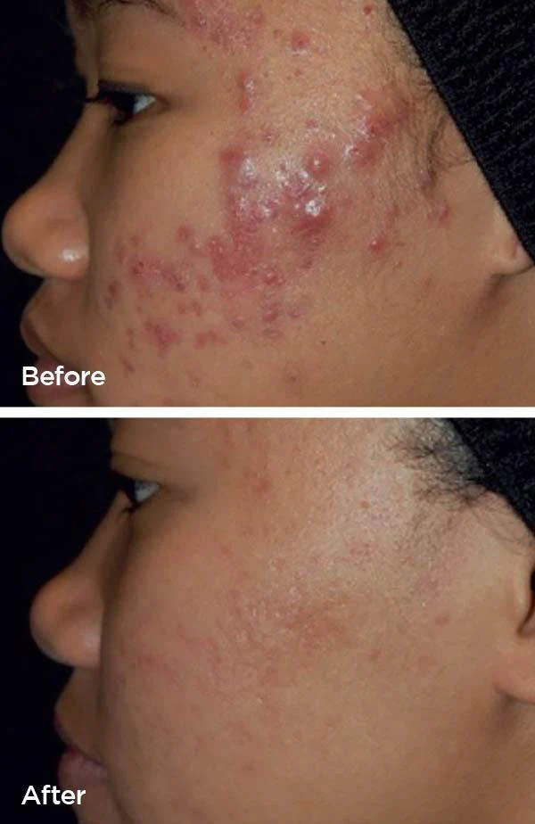 Laser Genesis before and after (acne and breakouts) at Beauty Studio MediSpa, Shenfield