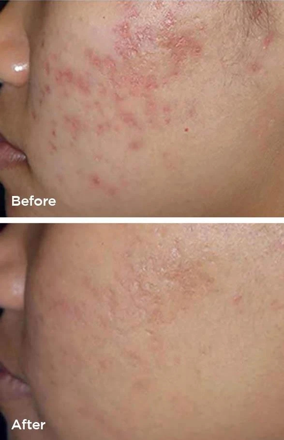 Laser Genesis before and after (uneven texture and redness) at Beauty Studio MediSpa, Shenfield