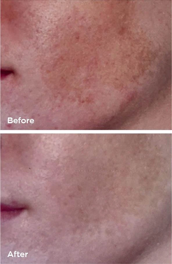 Laser Genesis before and after (fine lines and tone) at Beauty Studio MediSpa, Shenfield