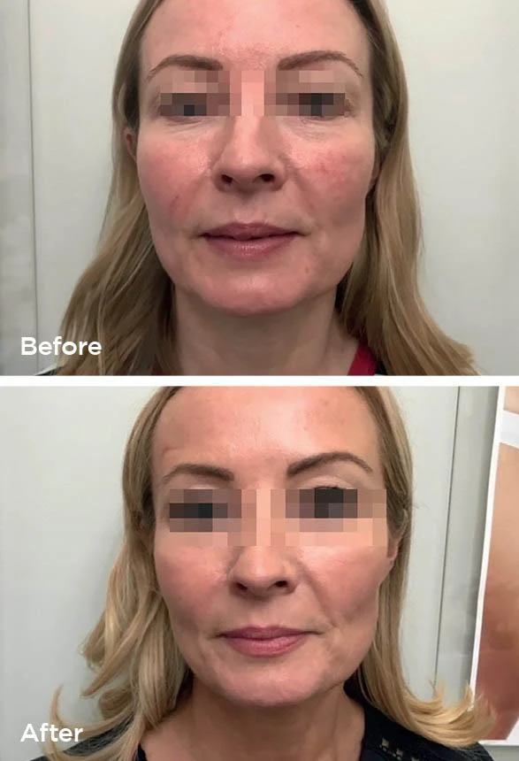 Laser Genesis before and after (facial redness) at Beauty Studio MediSpa, Shenfield