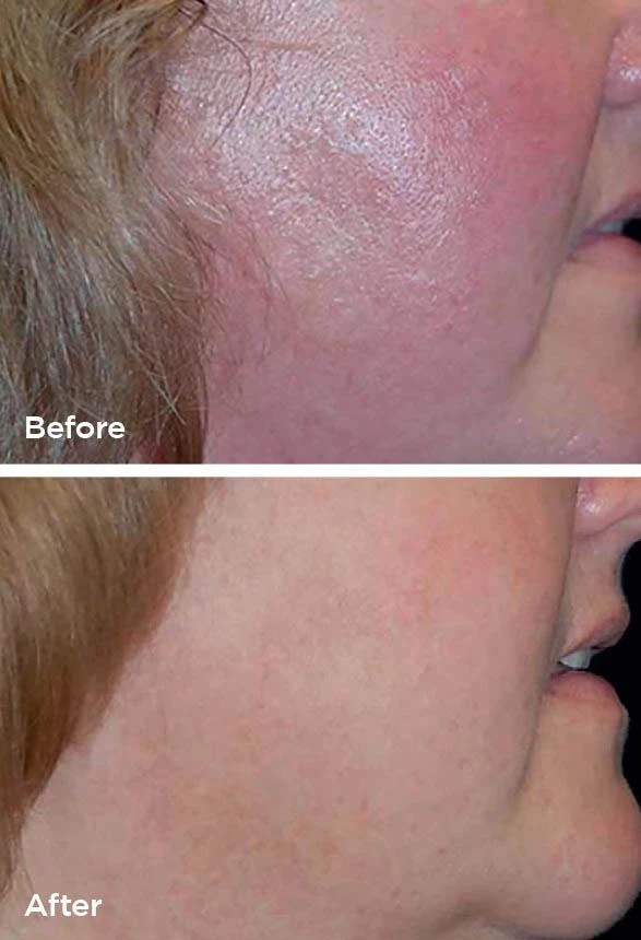 Laser Genesis before and after (acne scarring) at Beauty Studio MediSpa, Shenfield