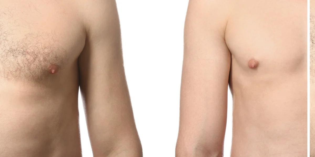 men's laser hair removal before and after at Beauty Studio MediSpa, Shenfield