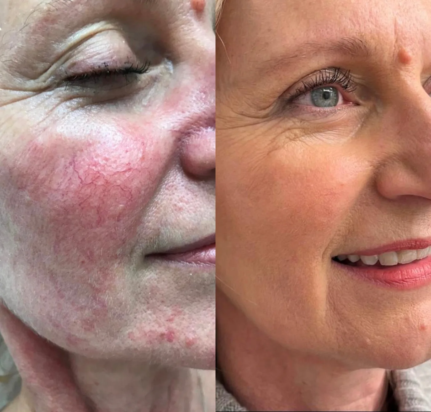 Limelight IPL skin rejuvenation before and after at Beauty Studio MediSpa, Shenfield