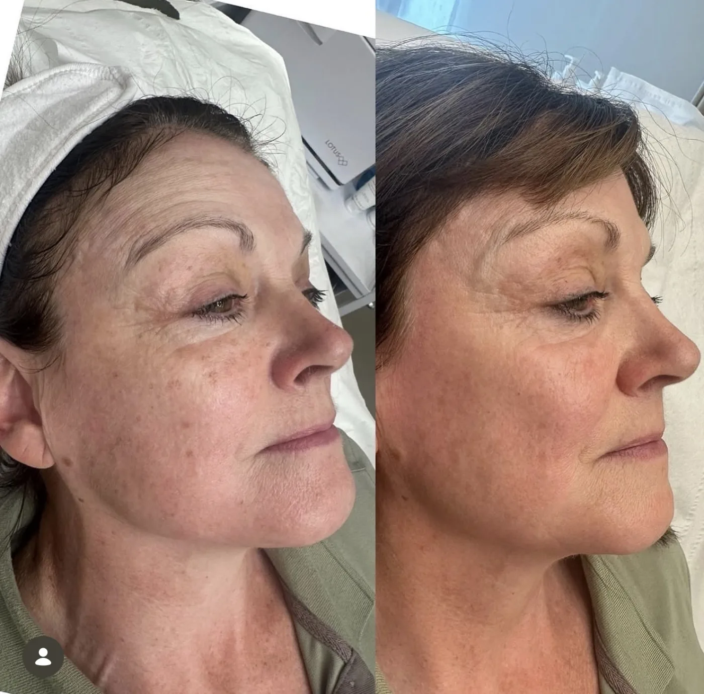 Limelight IPL skin rejuvenation before and after at Beauty Studio MediSpa, Shenfield