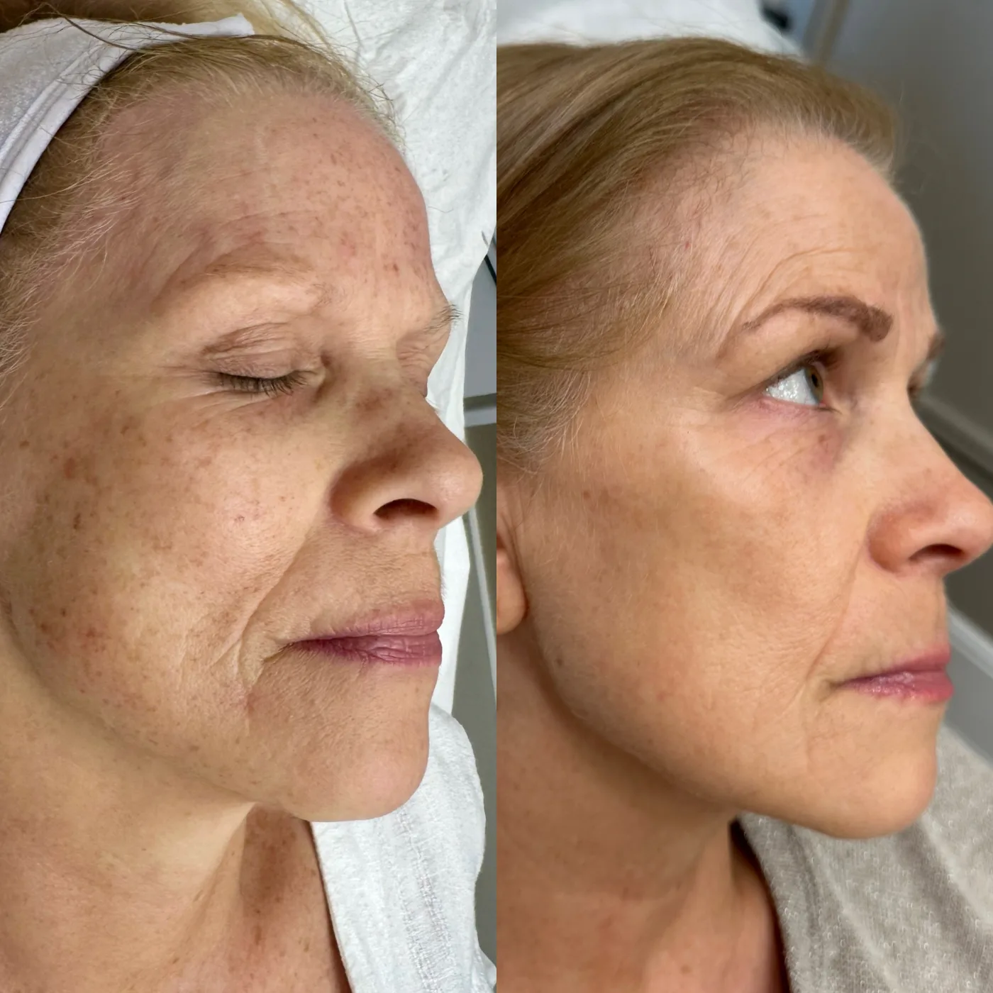 Limelight IPL skin rejuvenation before and after at Beauty Studio MediSpa, Shenfield