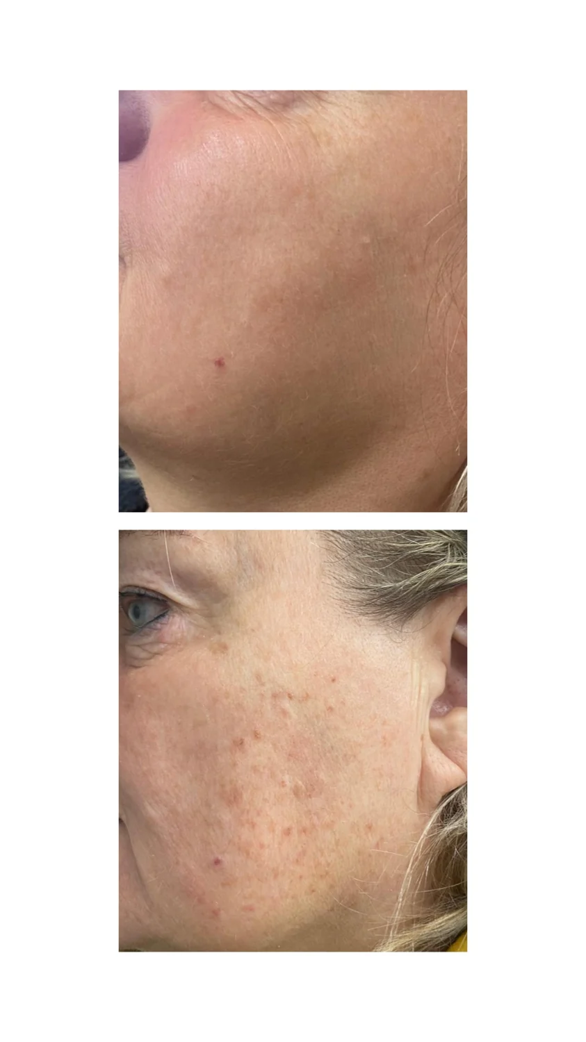 Limelight IPL before and after at Beauty Studio MediSpa, Shenfield