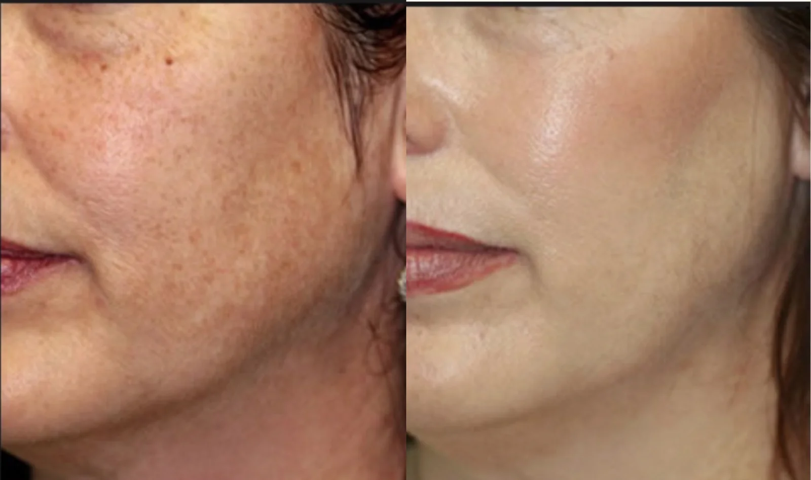 Limelight IPL before and after at Beauty Studio MediSpa, Shenfield