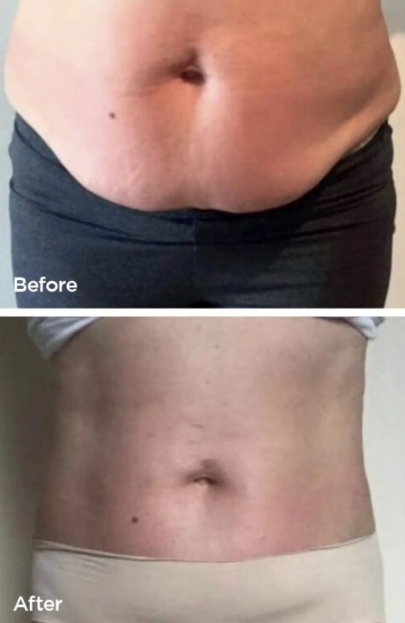 Lipofirm Pro body contouring before and after at Beauty Studio MediSpa, Shenfield