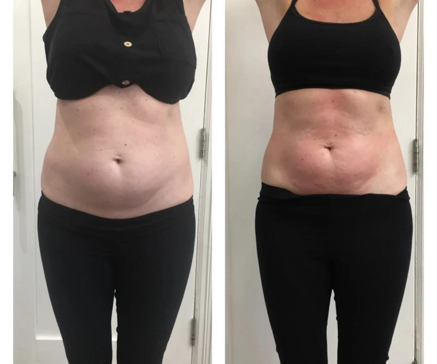 Lipofirm Pro body contouring before and after at Beauty Studio MediSpa, Shenfield