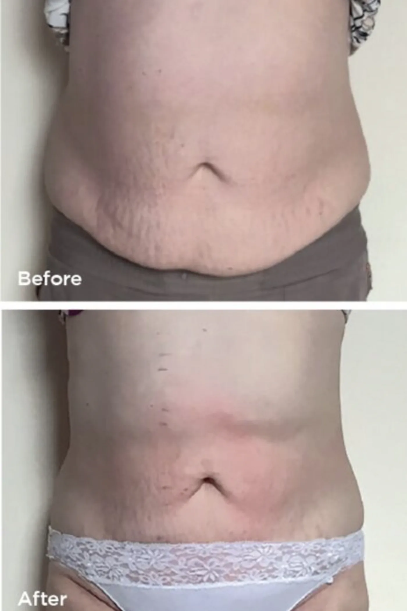 Lipofirm Pro body contouring before and after at Beauty Studio MediSpa, Shenfield