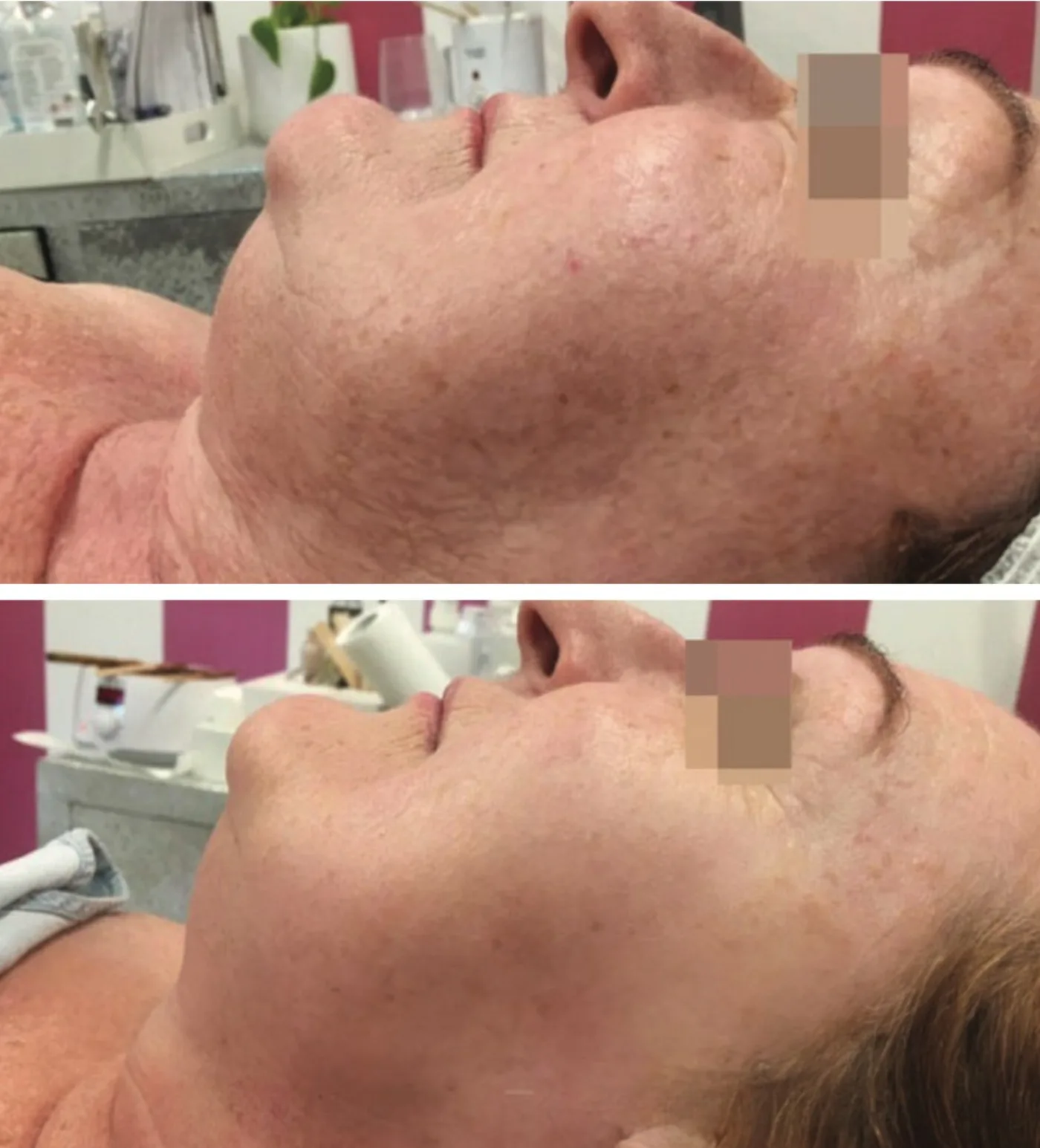 Microneedling before and after at Beauty Studio MediSpa, Shenfield