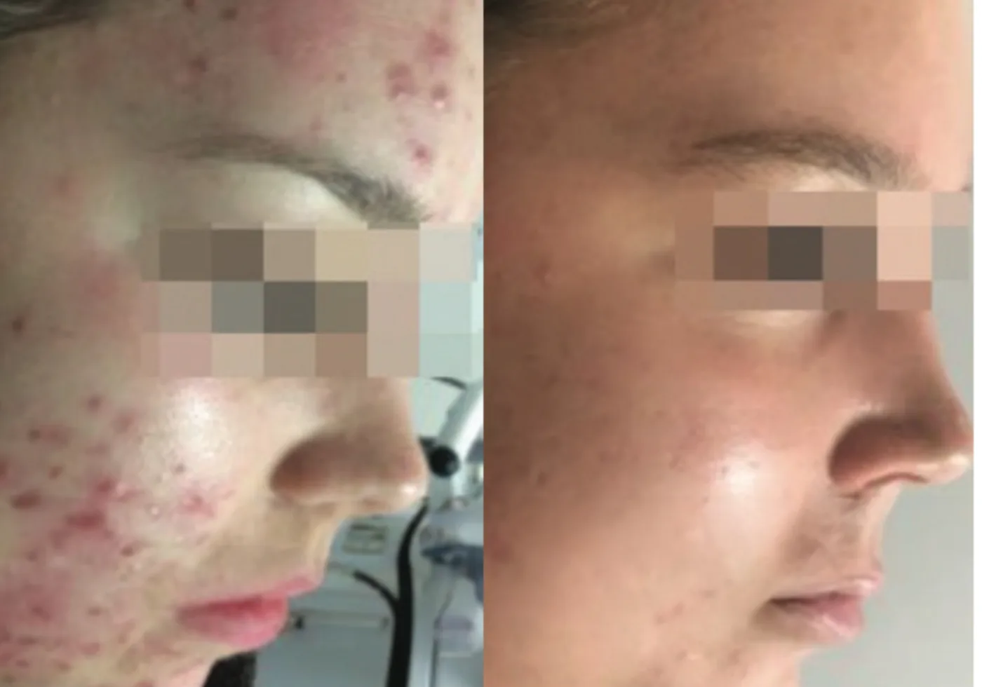 Microneedling before and after at Beauty Studio MediSpa, Shenfield