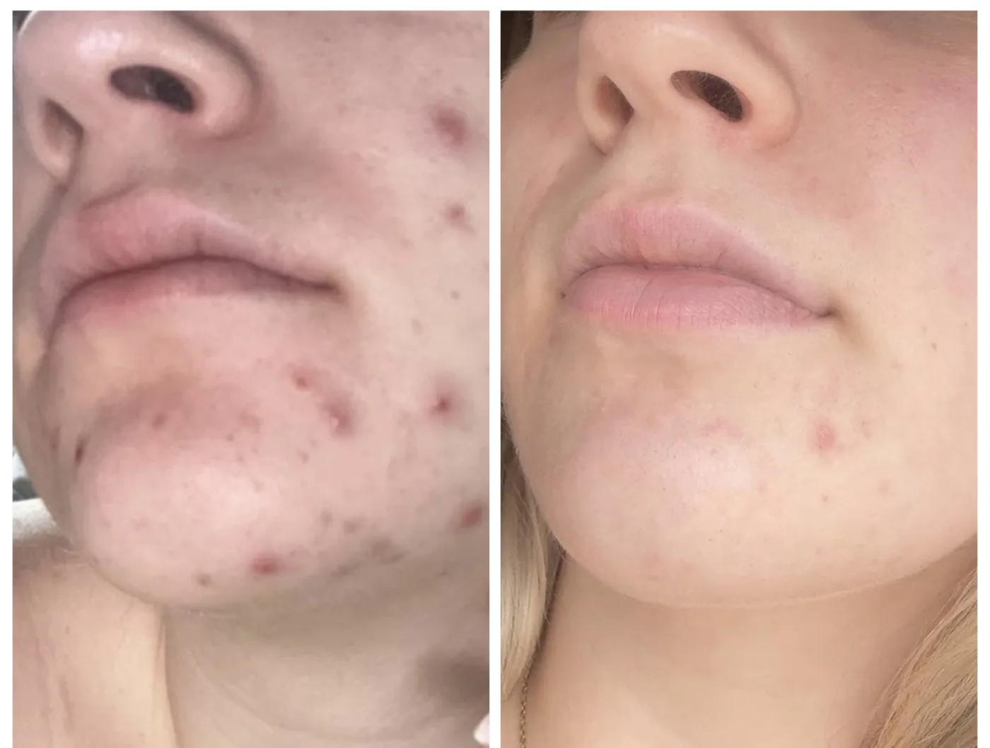 Microneedling before and after at Beauty Studio MediSpa, Shenfield