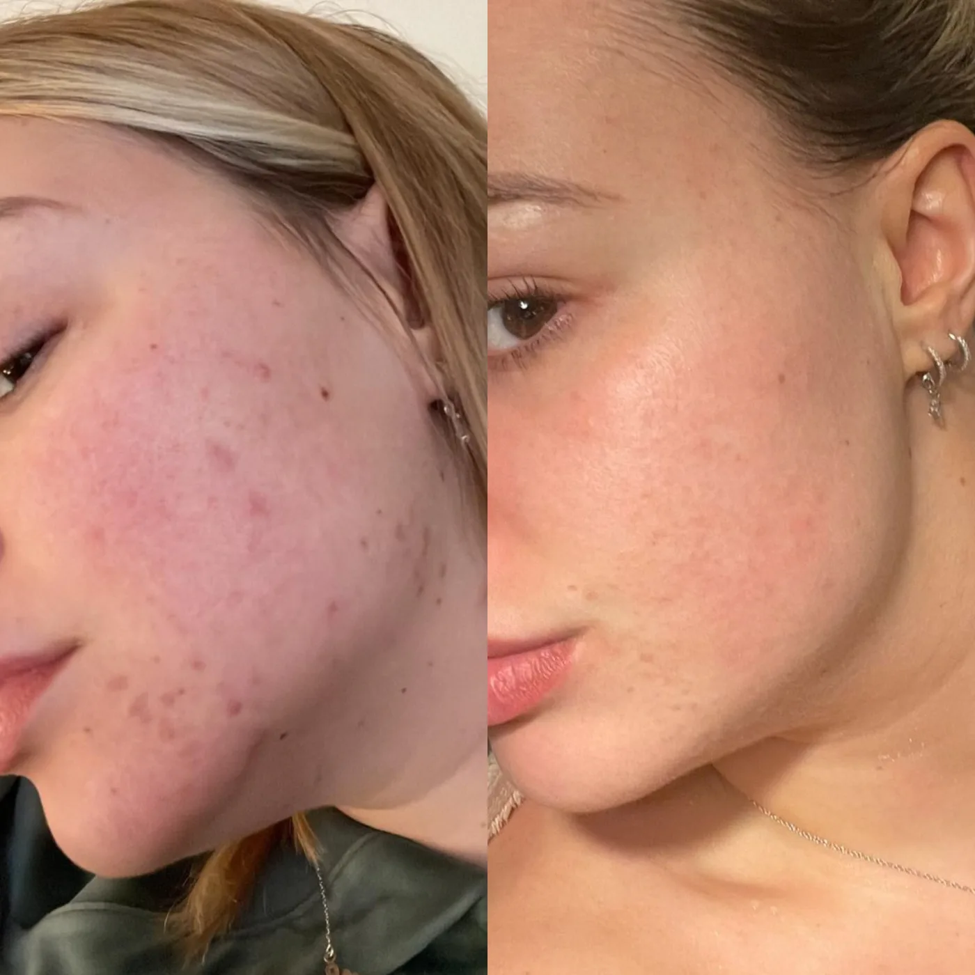 Microneedling before and after at Beauty Studio MediSpa, Shenfield