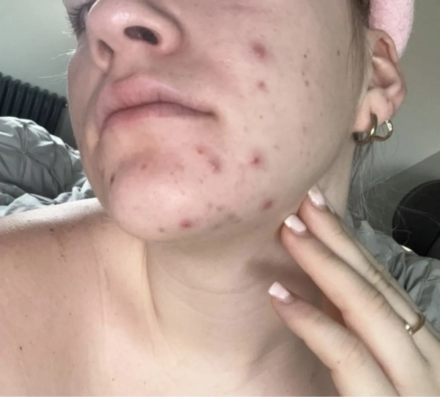 Microneedling before and after at Beauty Studio MediSpa, Shenfield