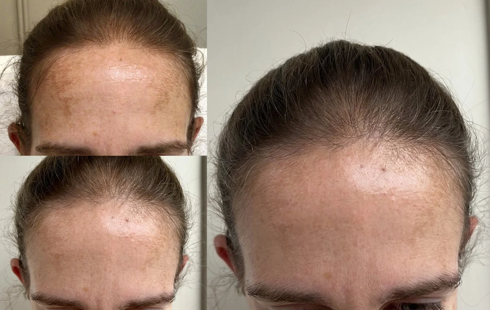 Microneedling before and after at Beauty Studio MediSpa, Shenfield