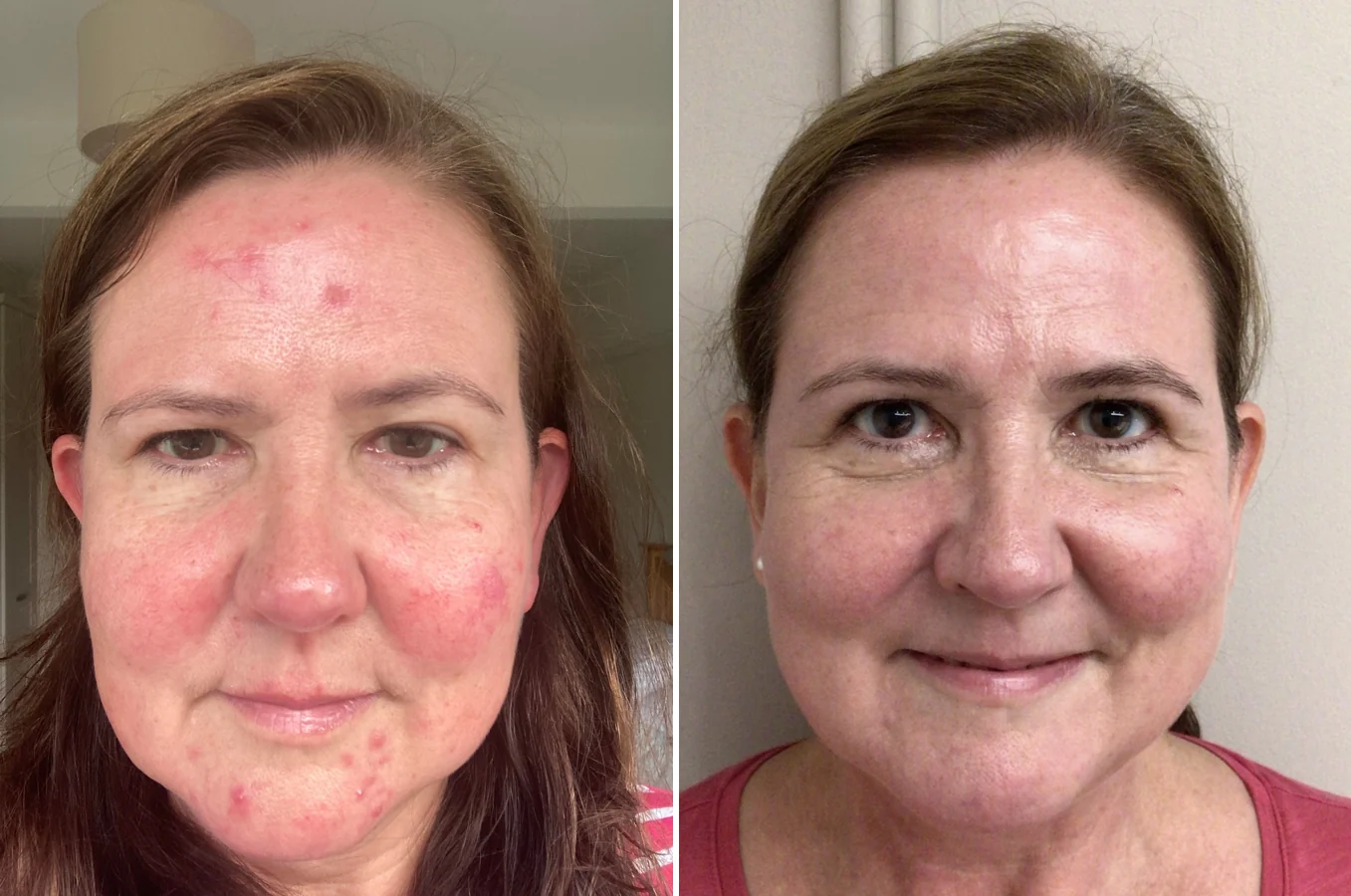 Precision Facials before and after at Beauty Studio MediSpa, Shenfield
