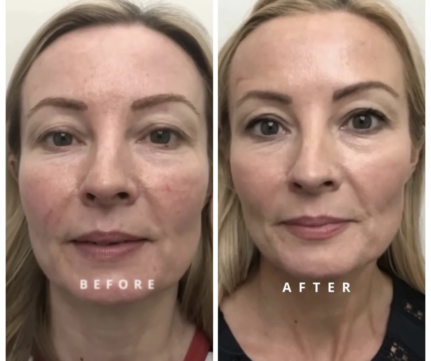 Precision Facials before and after at Beauty Studio MediSpa, Shenfield