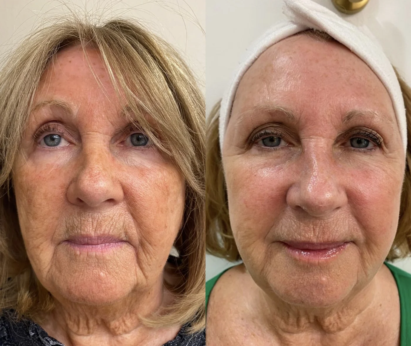 Precision Facials before and after at Beauty Studio MediSpa, Shenfield