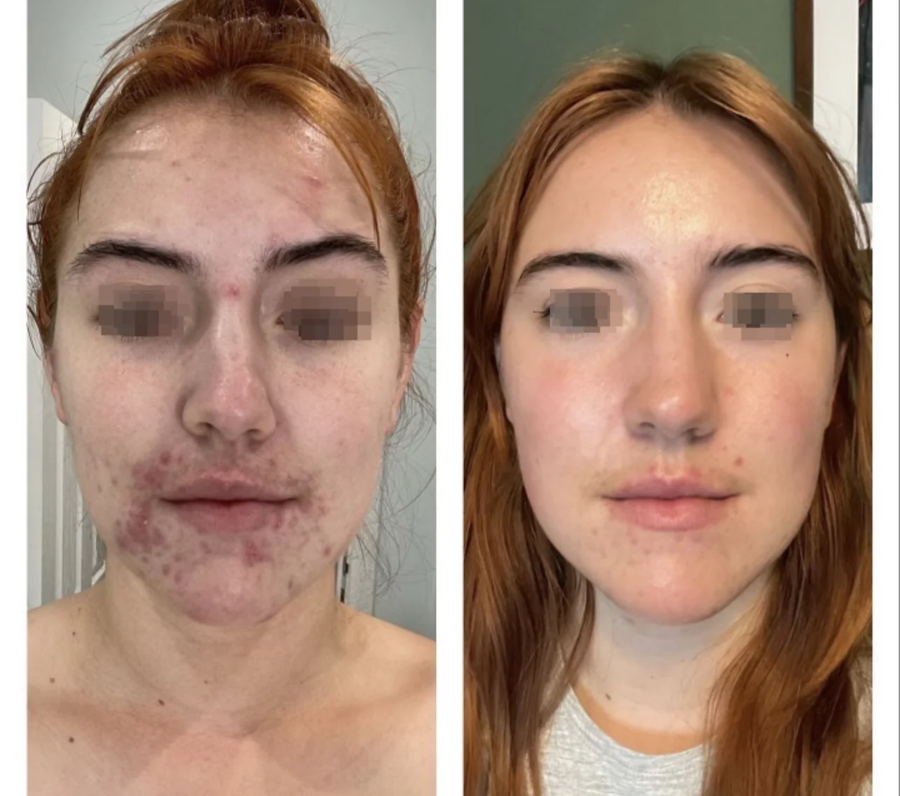 Precision Facials before and after at Beauty Studio MediSpa, Shenfield