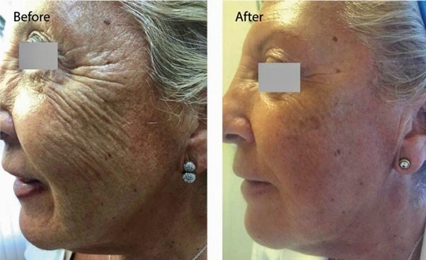 Profhilo before and after (skin quality and age spots) at Beauty Studio MediSpa, Shenfield