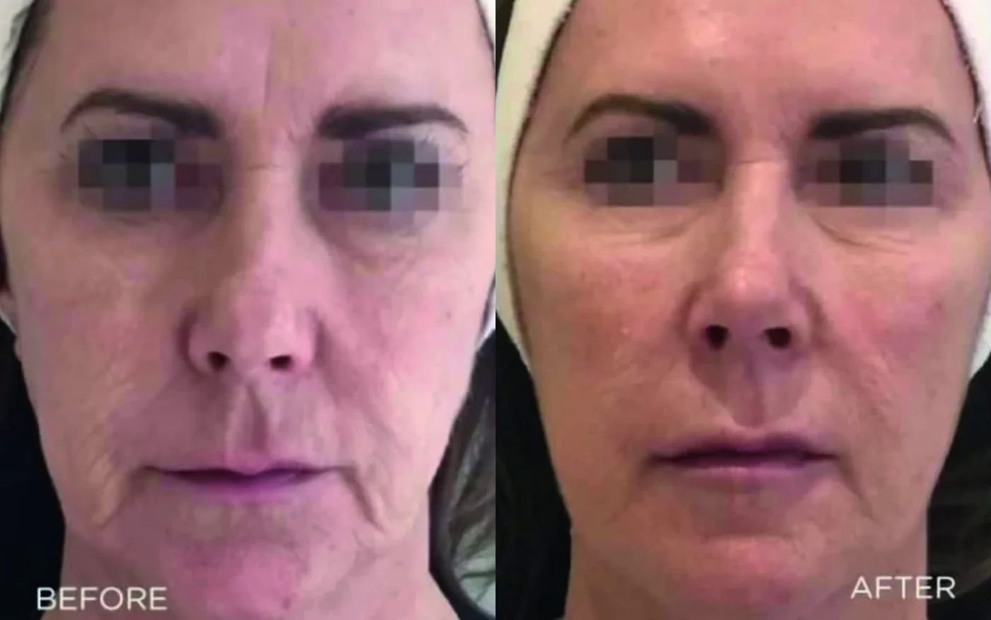 Profhilo before and after (skin quality and firmness) at Beauty Studio MediSpa, Shenfield