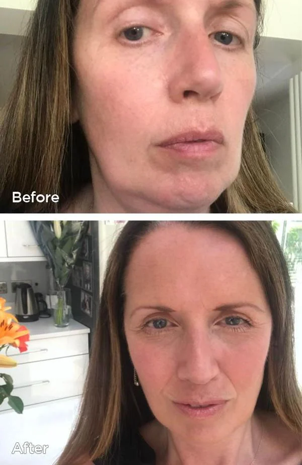 Tri-Polar RF facial before and after at Beauty Studio MediSpa, Shenfield