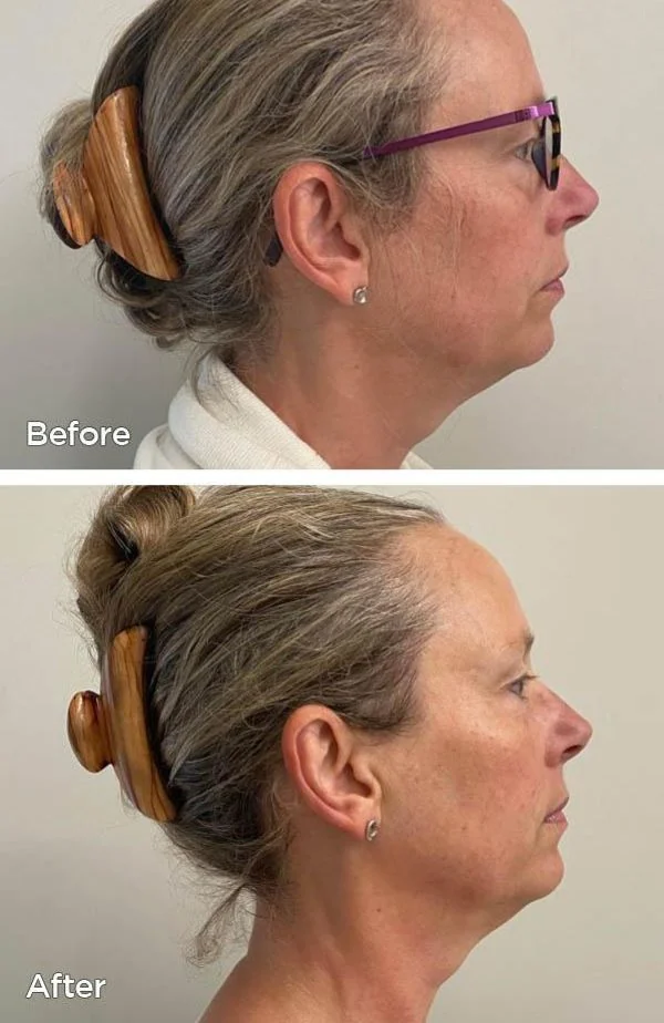 Tri-Polar RF facial before and after at Beauty Studio MediSpa, Shenfield