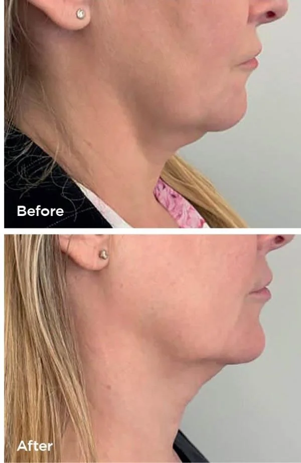 Tri-Polar RF facial before and after at Beauty Studio MediSpa, Shenfield