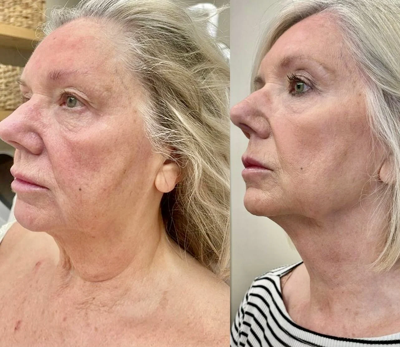 Sofwave before and after at Beauty Studio MediSpa, Shenfield