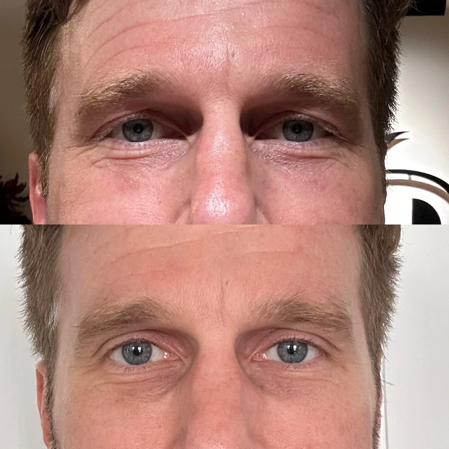 Sofwave before and after at Beauty Studio MediSpa, Shenfield