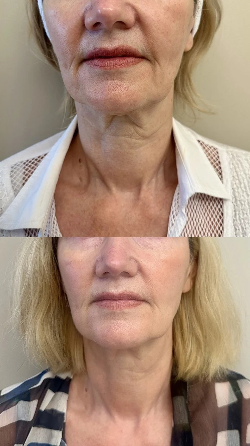Sofwave before and after at Beauty Studio MediSpa, Shenfield