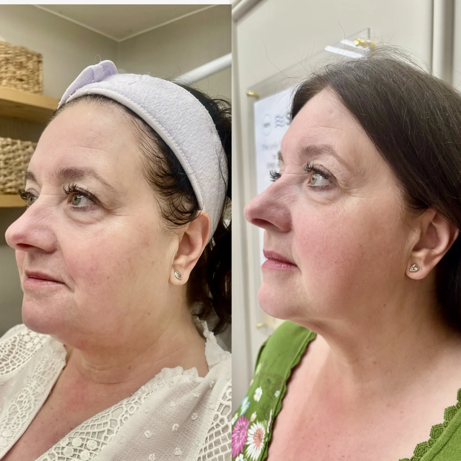 Sofwave before and after at Beauty Studio MediSpa, Shenfield