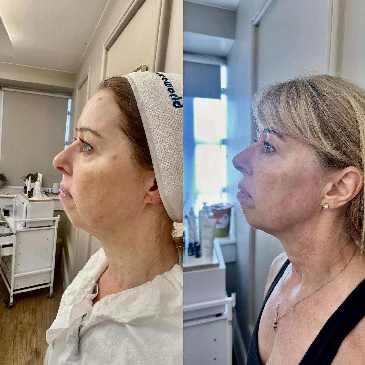 Sofwave before and after at Beauty Studio MediSpa, Shenfield