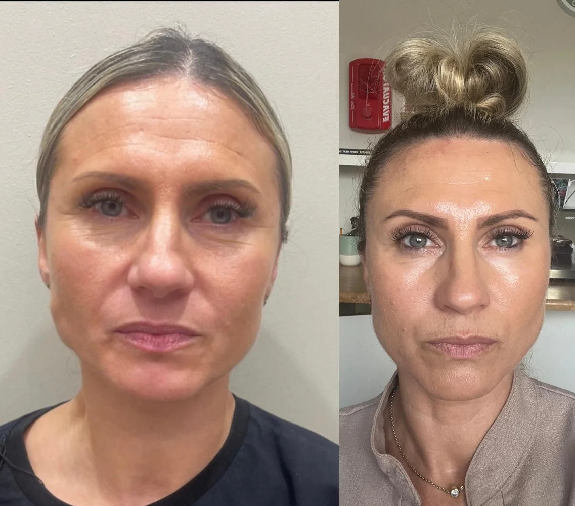 Sofwave before and after at Beauty Studio MediSpa, Shenfield
