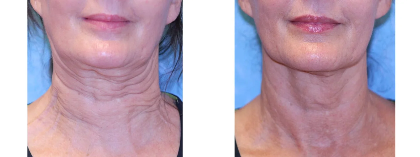 Sofwave before and after at Beauty Studio MediSpa, Shenfield