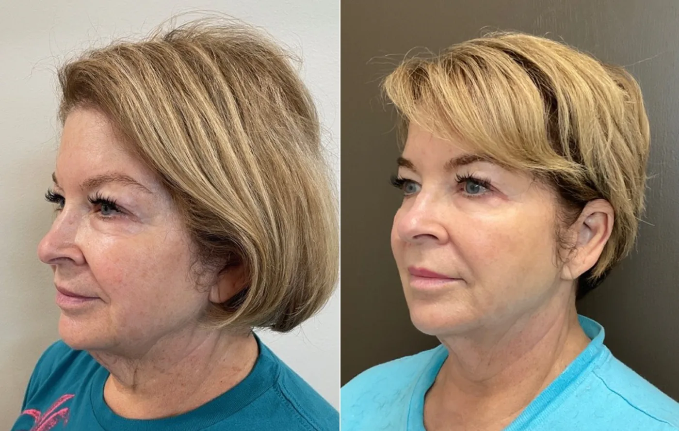 Sofwave skin tightening before and after at Beauty Studio MediSpa, Shenfield