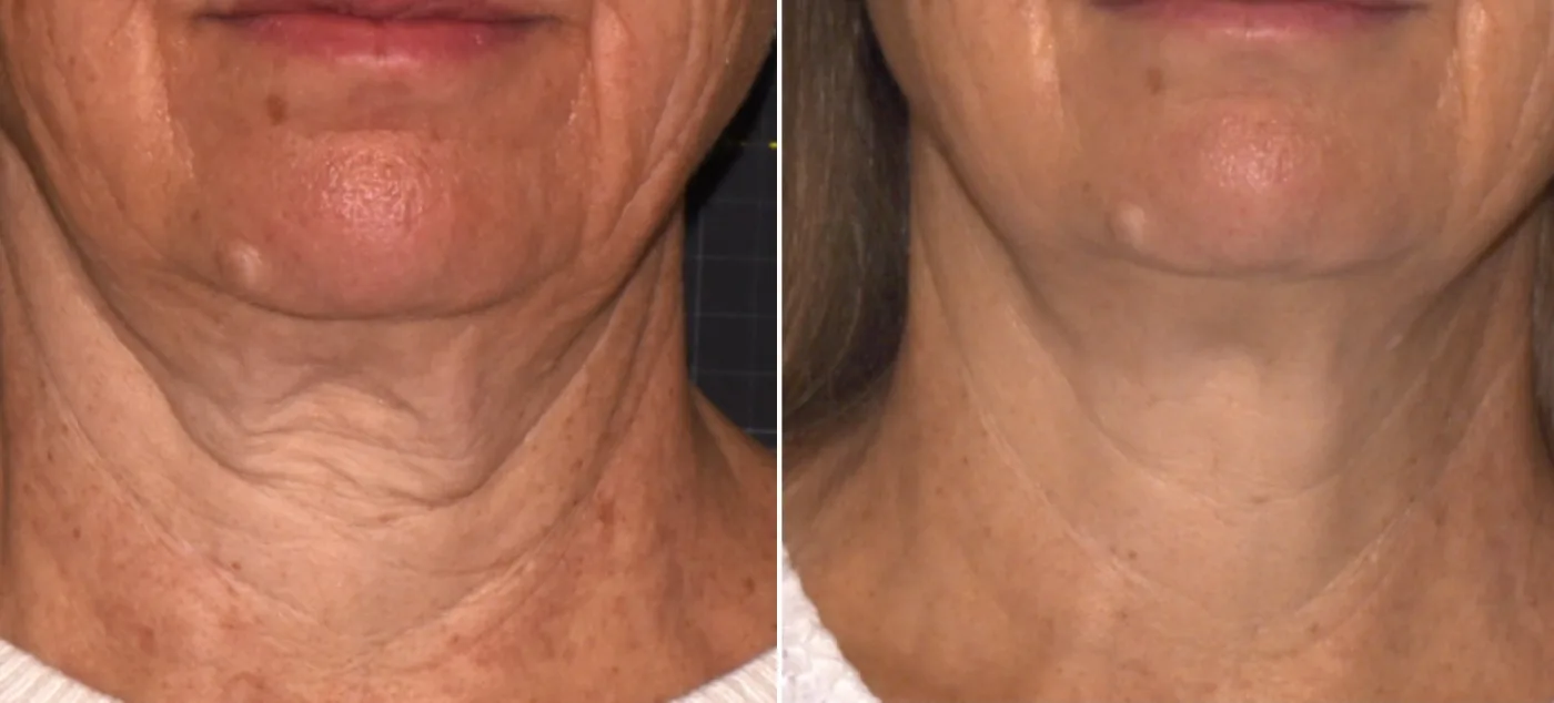 Sofwave skin tightening before and after at Beauty Studio MediSpa, Shenfield