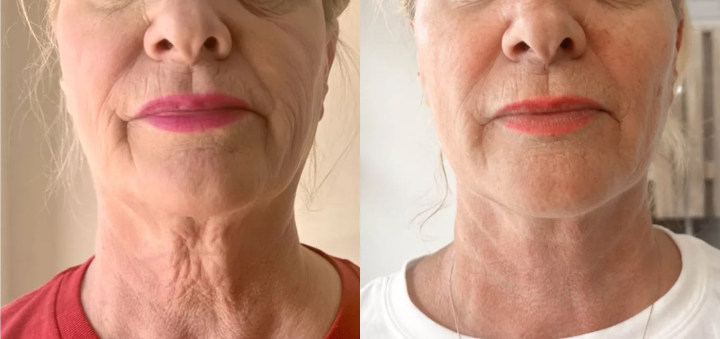 Sofwave skin tightening before and after at Beauty Studio MediSpa, Shenfield